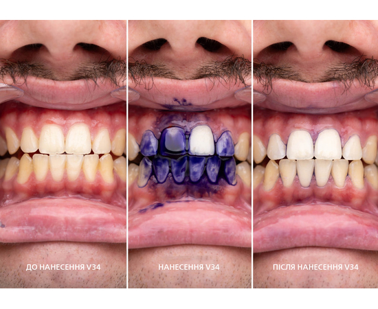 SmileKit V34 Корректор цвета зубов, 30 мл, изображение 9
